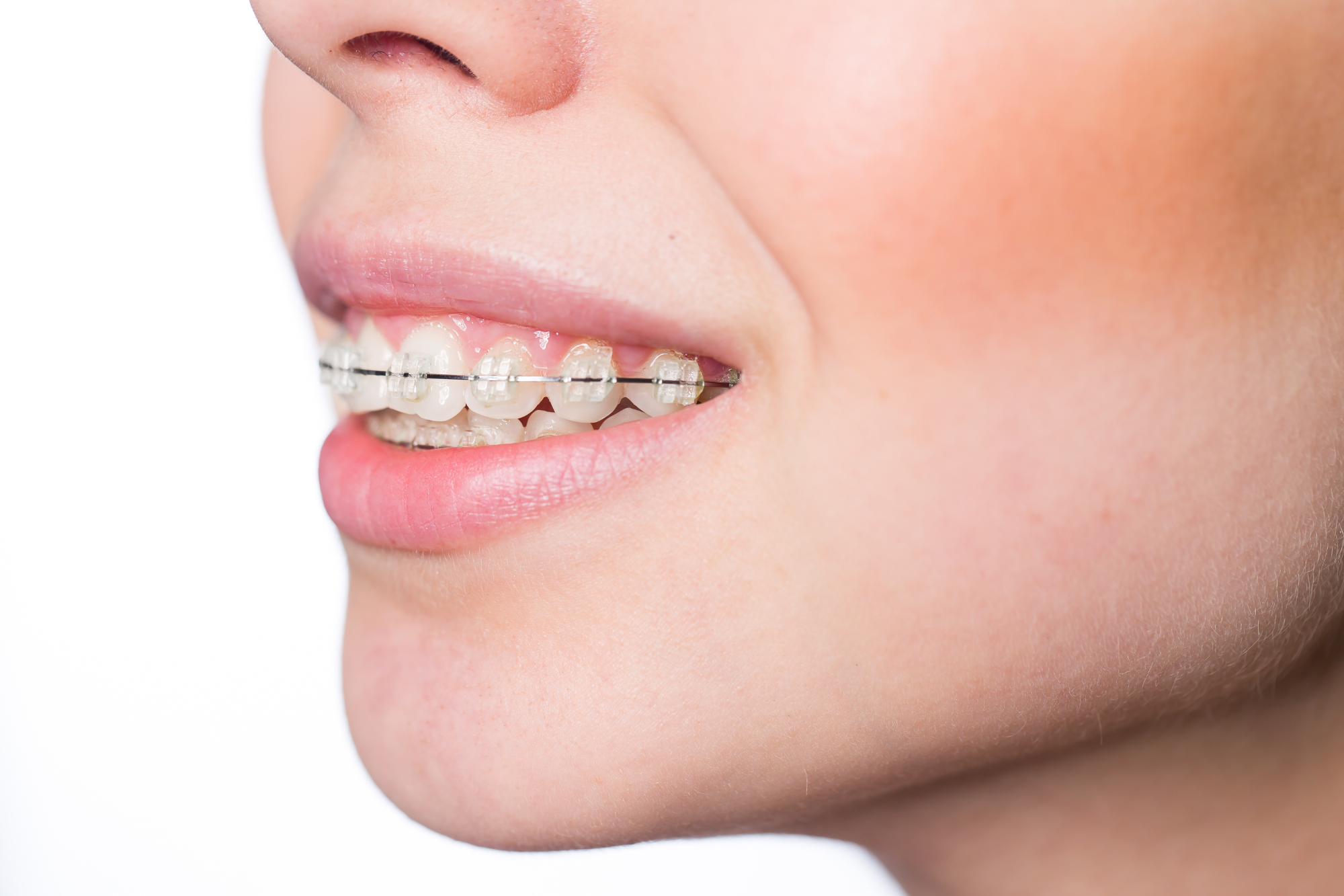 ワイヤー矯正の治療期間はどれくらい？時間がかかるかも解説！