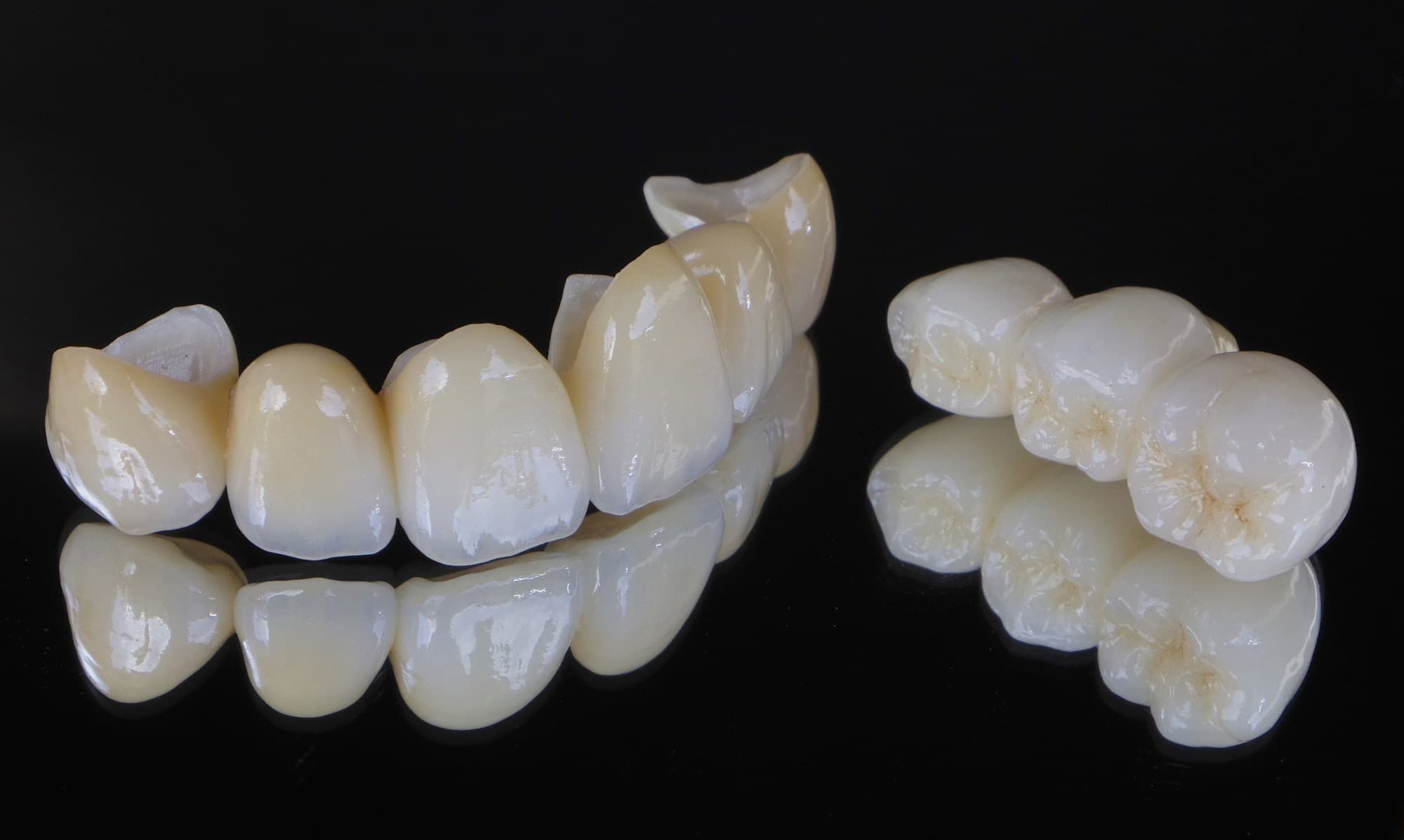 セラミック治療とは？種類や費用、メリット・デメリットの紹介