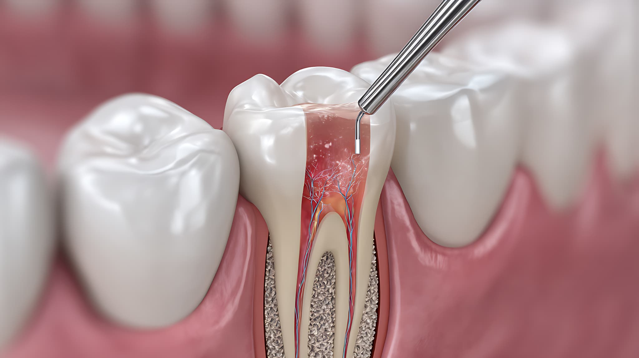 根管治療のやり直しが必要な理由と費用・リスクとは?