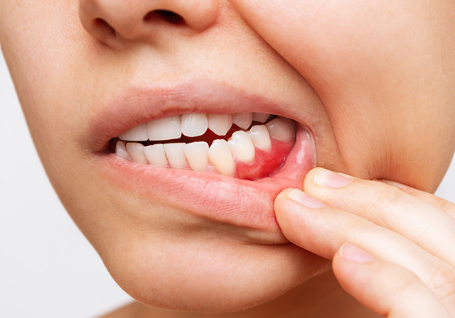 歯茎が腫れている女性