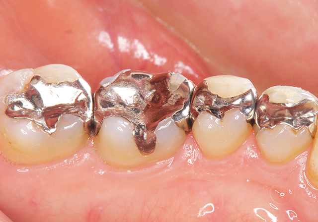 インレー処置がされている歯