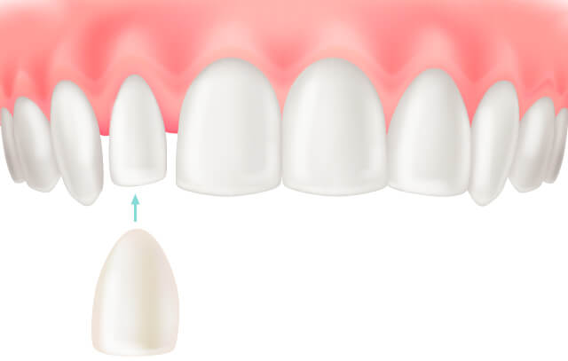 ラミネートべニア