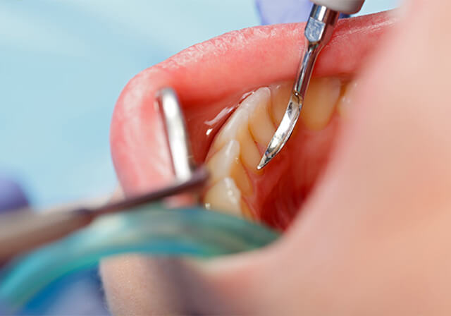 スケーリング（歯石取り）